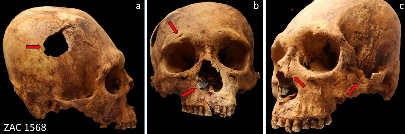 Various-Traumatic-Injuries-Skeleton.jpg