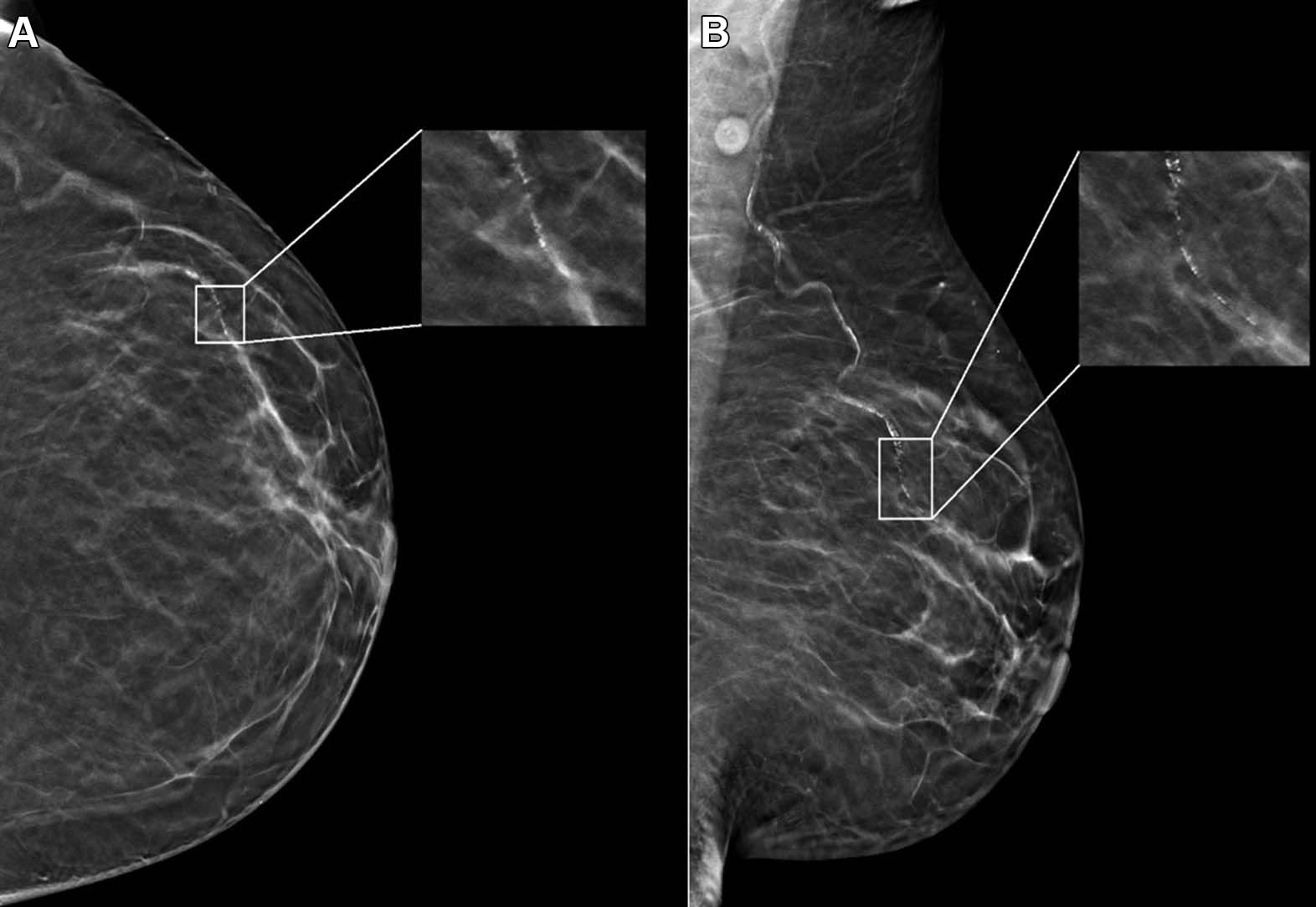 Example-Mammogram-Assigned-False-Positive-Case-Score.jpg