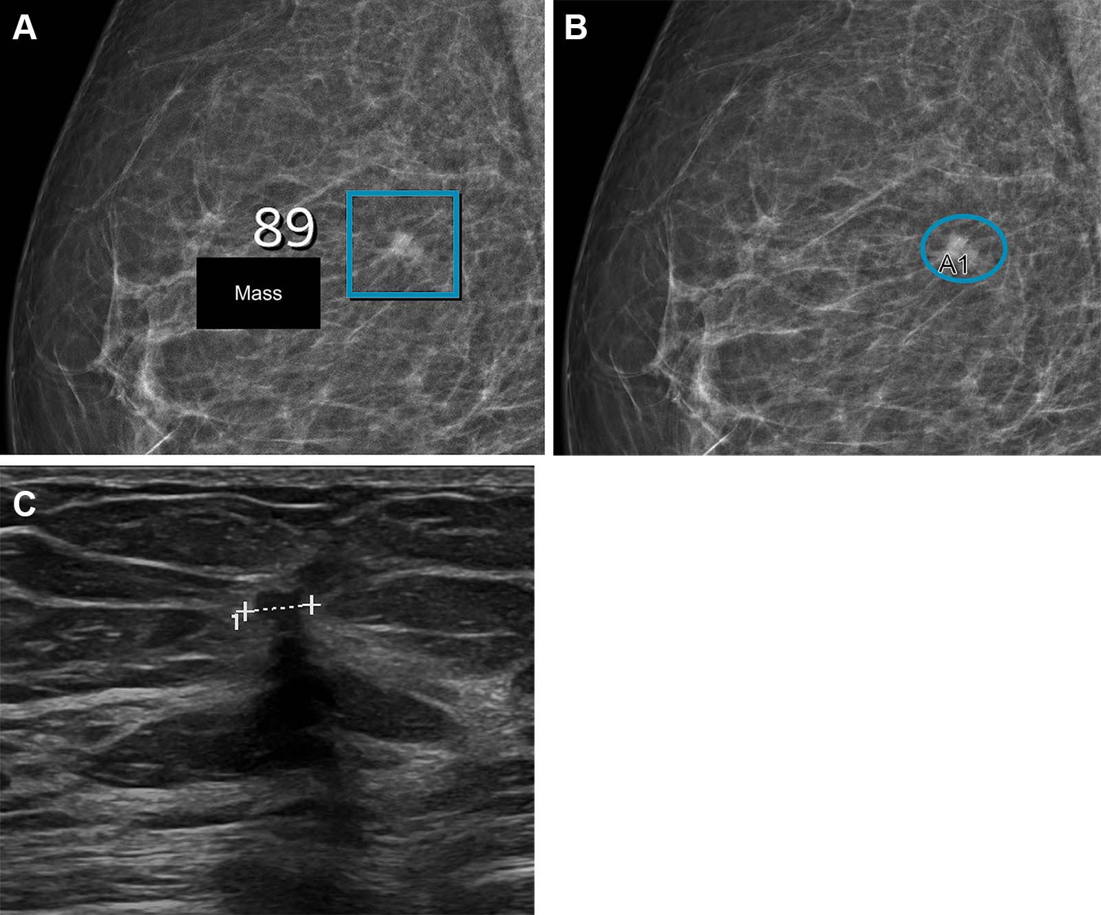 Breast-Imaging-Reporting-and-Data-System-Density-of-2.jpg