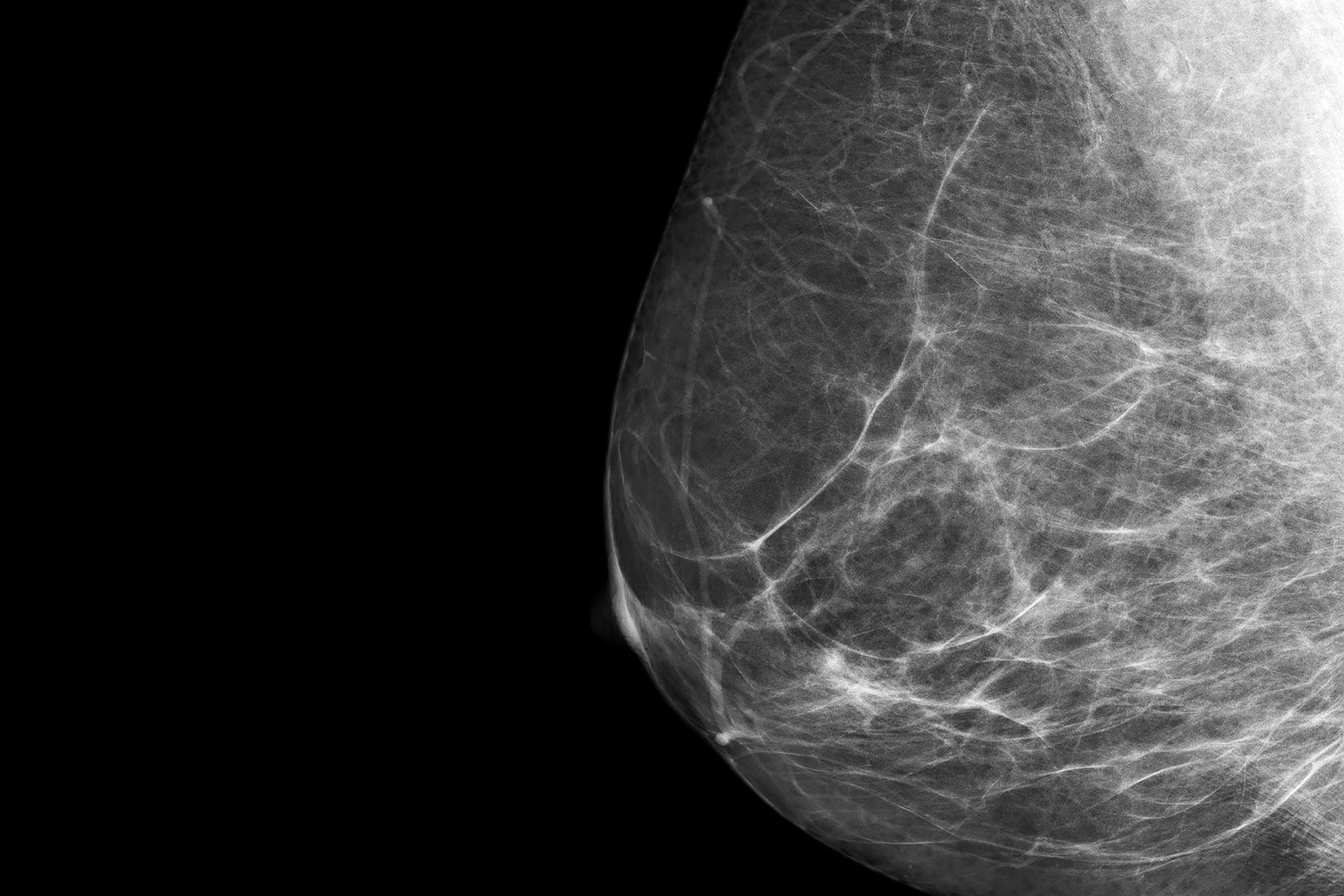 Breast-Cancer-X-Ray-Mammogram-Close-Up.jpg