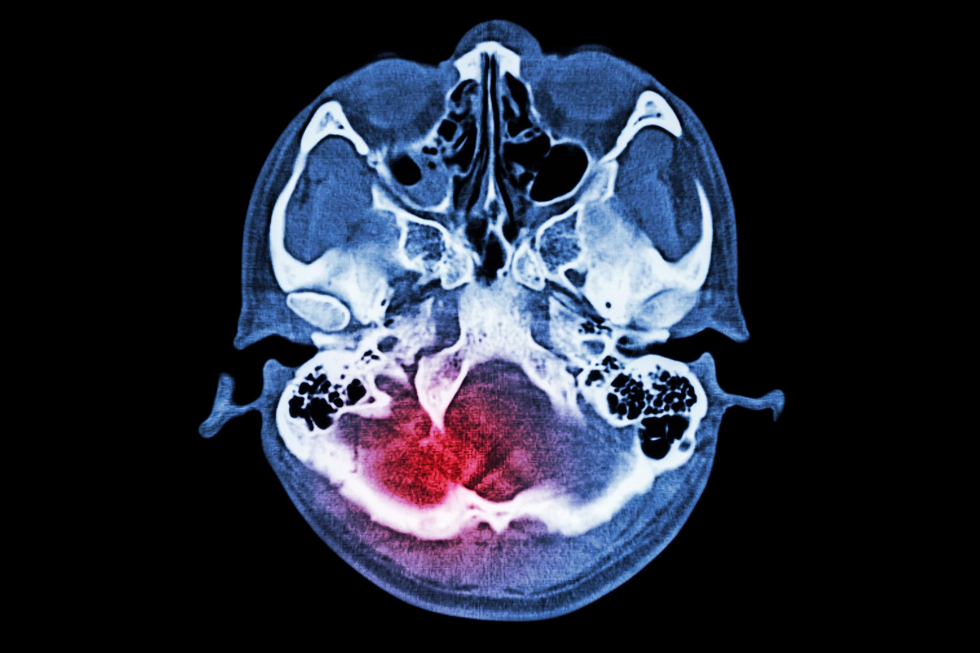 Brain-Injury-Stroke.jpg