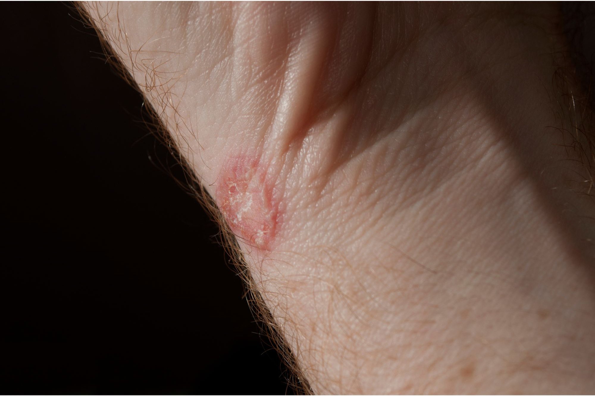 Ringworm-Wrist.jpg
