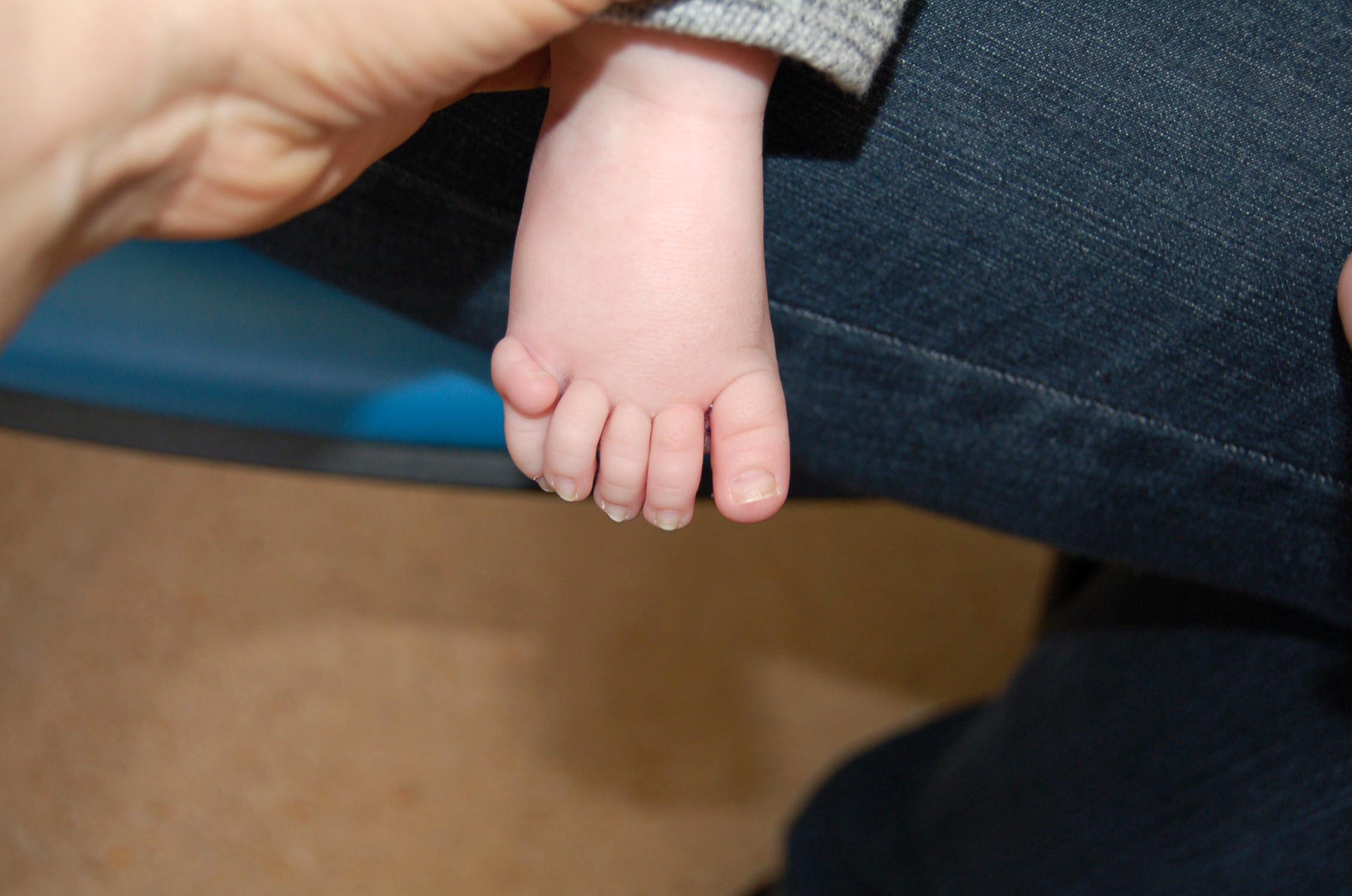 Child-With-Extra-Toe.jpg