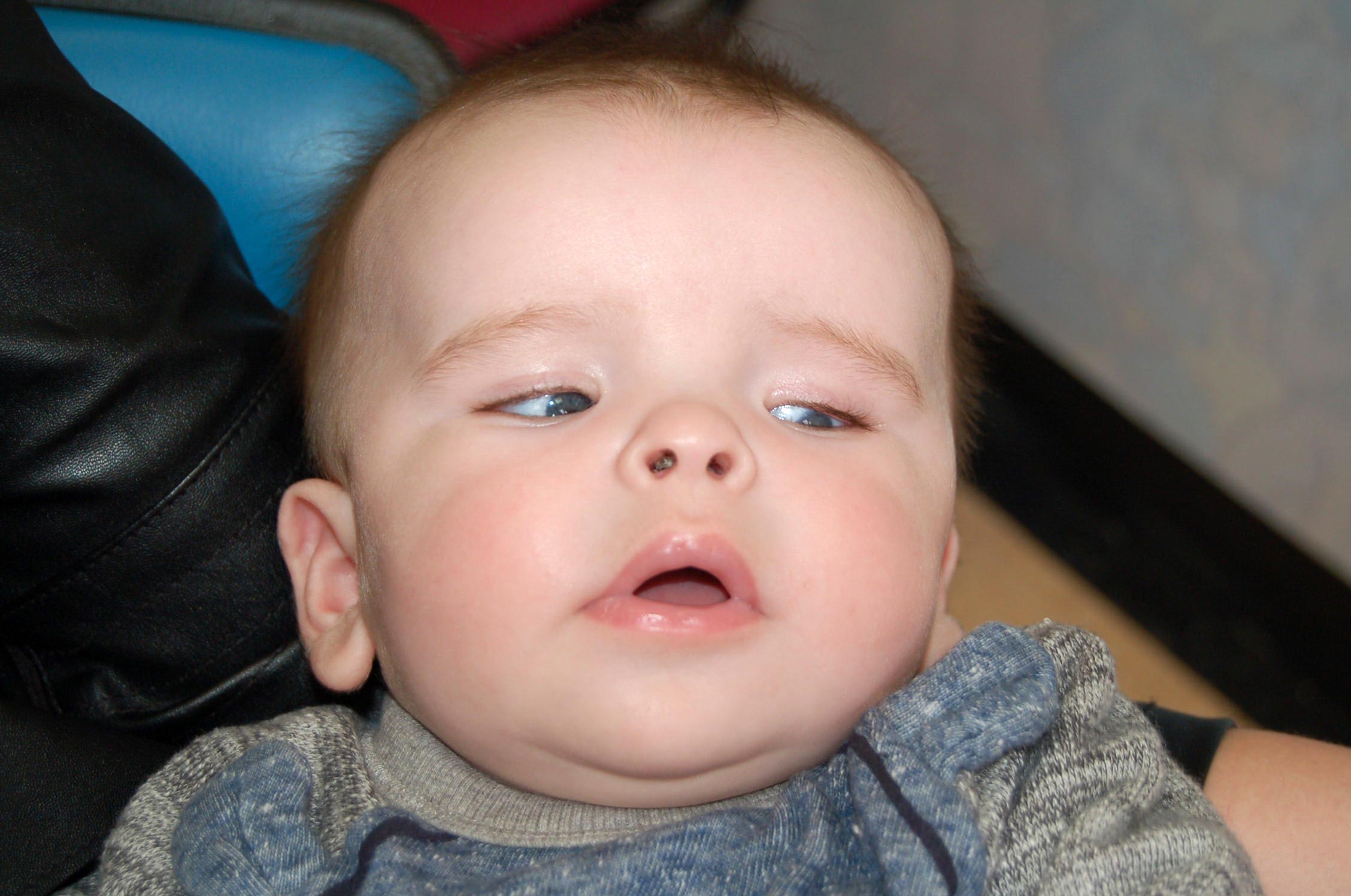 Child-With-Macrocephaly.jpg