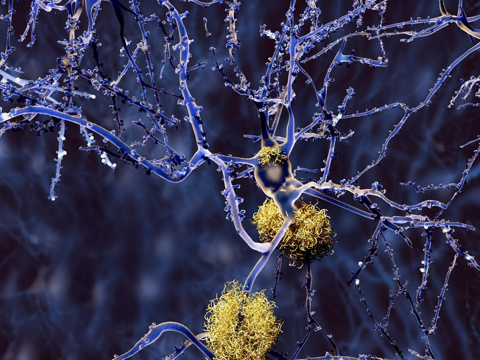 Alzheimer-Disease-Neurons-With-Amyloid-Plaques.jpg