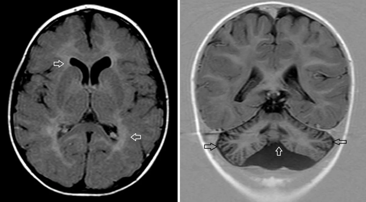 Brain-Scans-of-Patient-With-Genetic-Disease-Caused-by-CCT3-Variants.webp