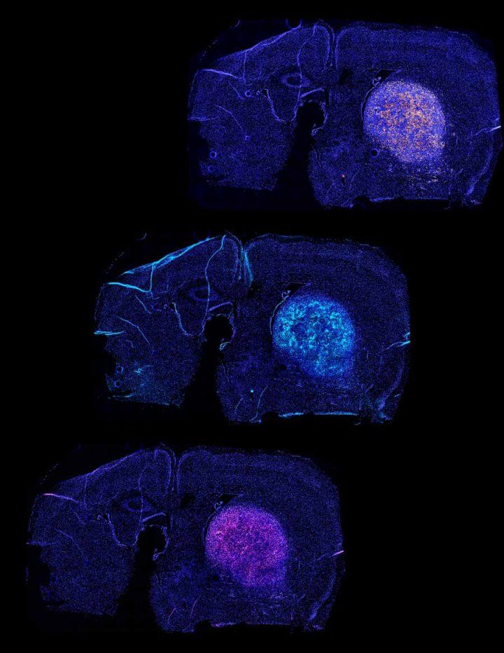 T-cells-attacking-glioblastoma-vertical.jpg