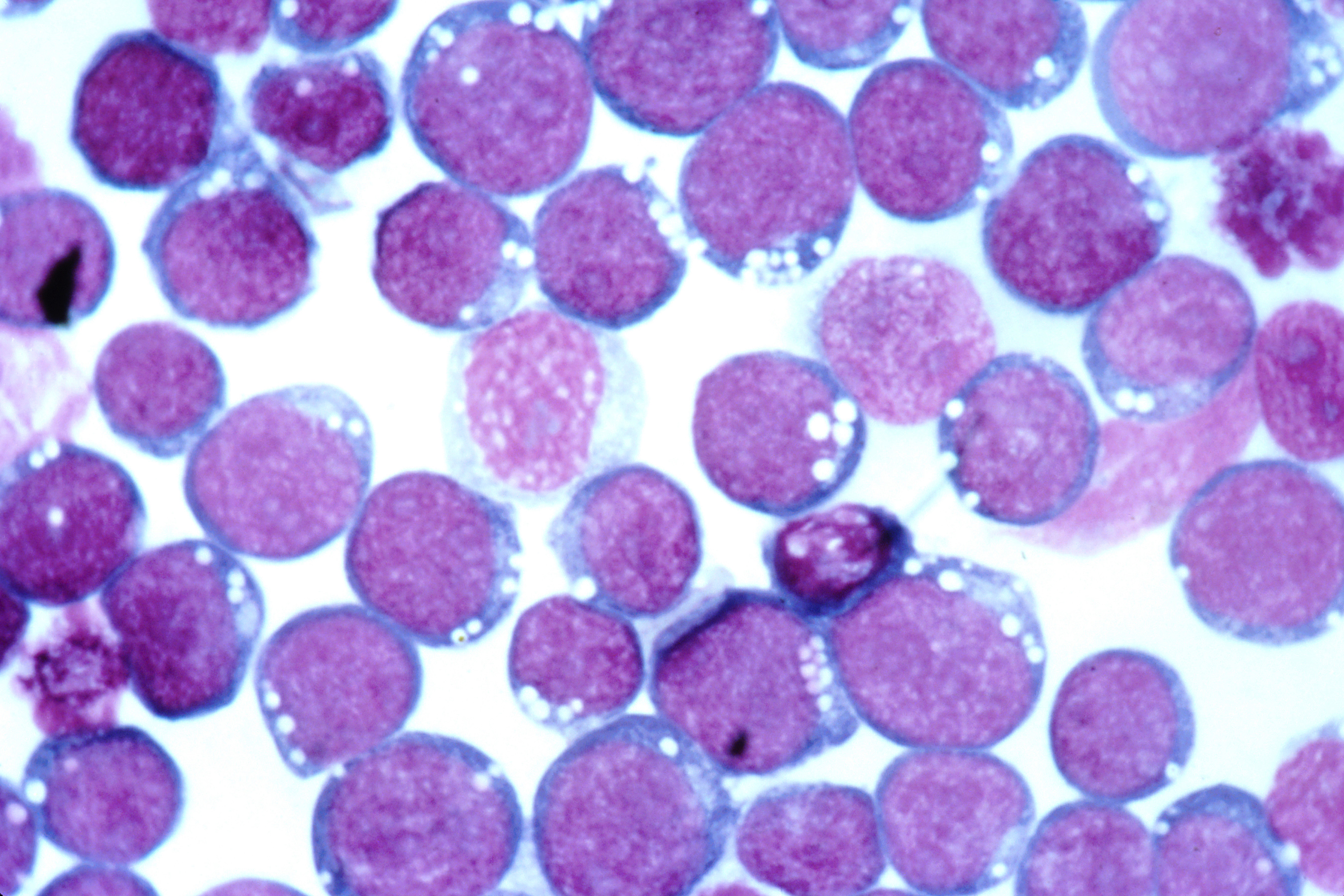 Epstein-barr_virus_(ebv).jpg