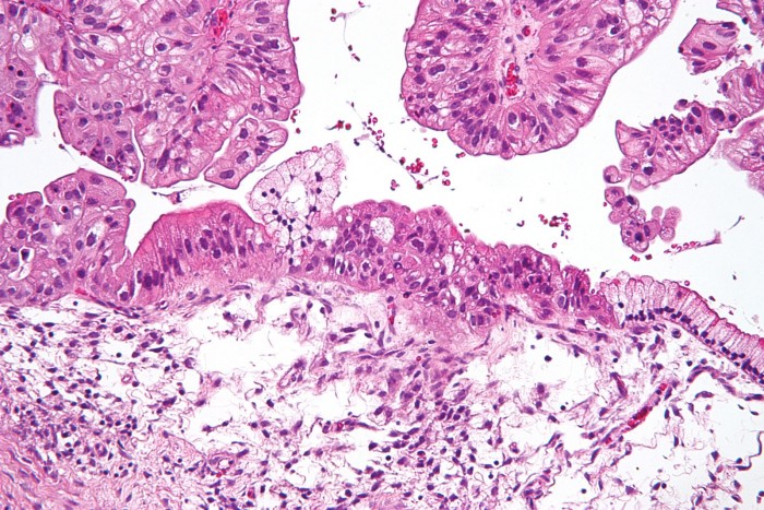 1599px-Mucinous_lmp_ovarian_tumour_intermed_mag.jpg