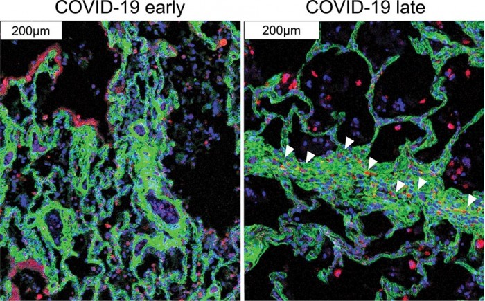 COVID-19-Lung-Pathology.jpg