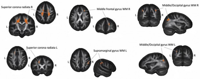 Learning-Braille-Changes-Brain-Structure.jpg
