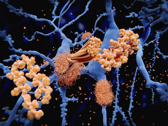 Amyloid-Protein-Clumps-Along-Neurons.jpg