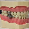 器械辅助“管住嘴”：DentalSilm Diet Control装置被证实有减肥奇效