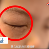 女孩一做数学题就眼睛过敏：眼睛肿到睁不开