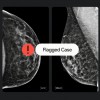 Google与iCAD合作 通过AI改善乳腺癌筛查