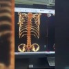 男子因缺钙CT图像中没有肋骨：“像一个透明人”