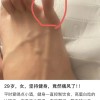 痛风，正在席卷中国年轻人......