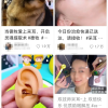 耳朵里长“脚气” 竟然是因为这个很多人都爱的活动……