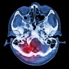 科学家发现10种生活方式因素与中风风险和严重程度有关